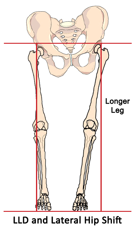 Leg Length Discrepancy: Is it Causing Your Pain and Dysfunction? - NETA